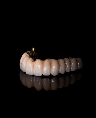 Prótesis fija sobre implantes elaborada por Juiz Dental