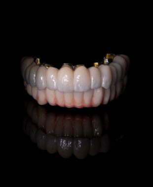 Prótesis híbrida sobre implantes elaborada por Juiz Dental