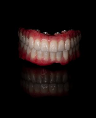 Sobredentadura completa elaborada por Juiz Dental